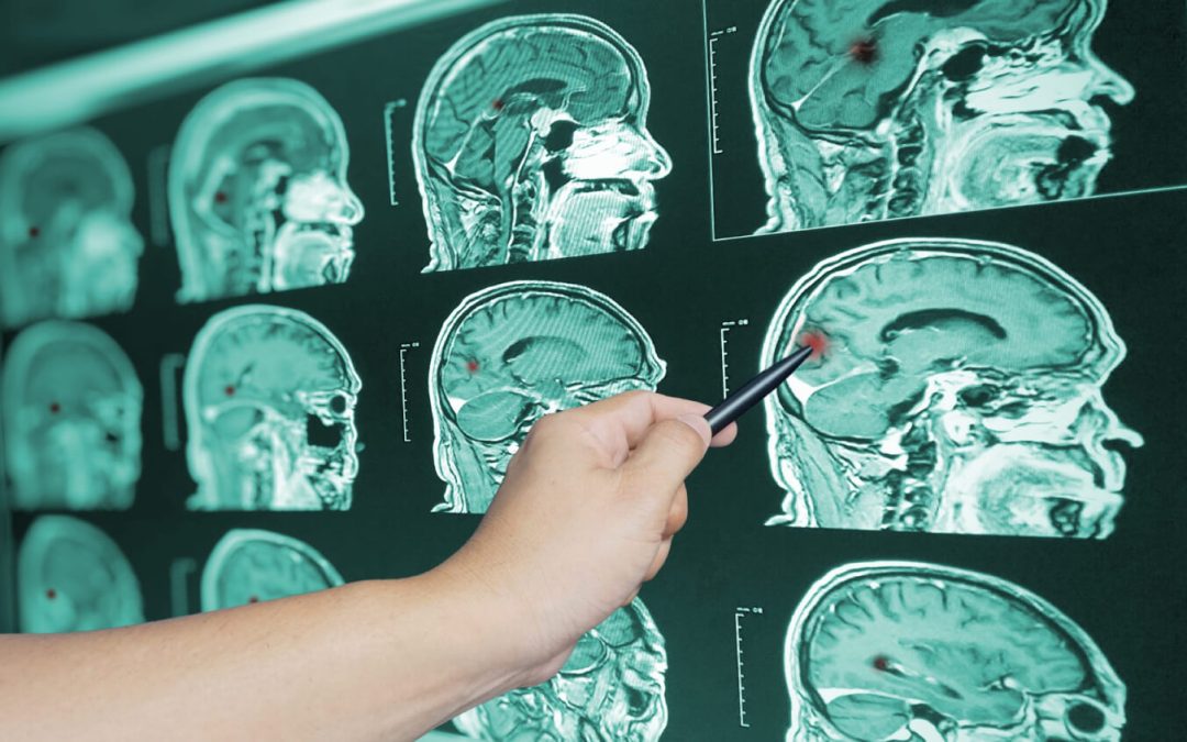 How Long Does It Take to Recover From a Traumatic Brain Injury?